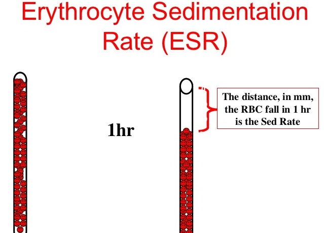 esr-erythrocyte-sedimentation-rate-medical-programmer